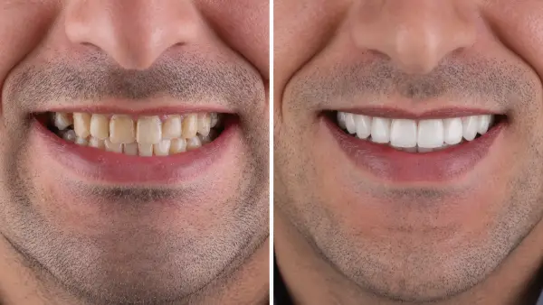 Carillas dentales